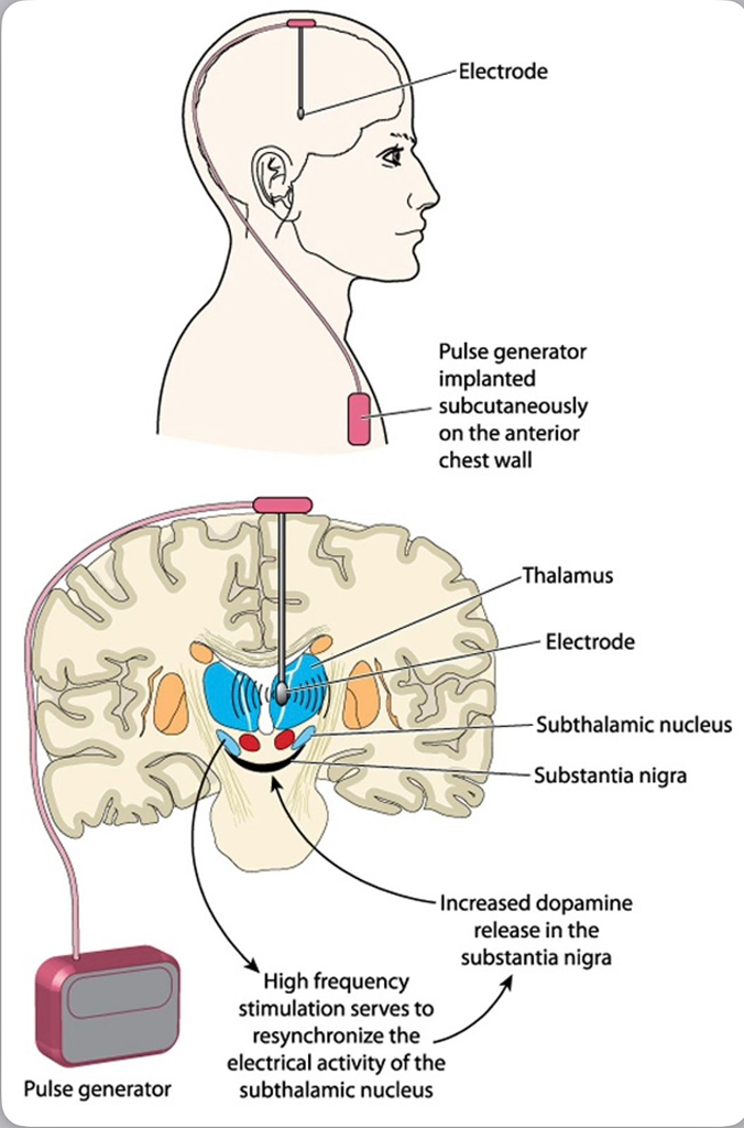 Cross section of the brain showing DBS electrode placement targets